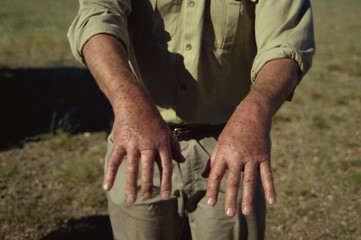 Tourist's hands with mosquito bites, Namibia