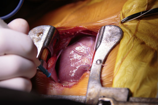 Open child's heart surgery with opened thorax and beating heart close-up