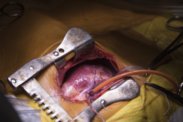 Three-year child heart with connected tubes of heart-assist device during the surgery