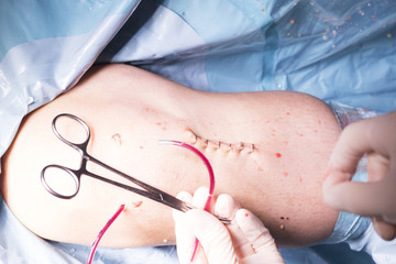 Surgical operation knee surgery