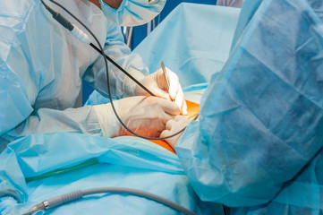 Complex laparoscopic operation on a peritoneal cavity is carried out in four hands