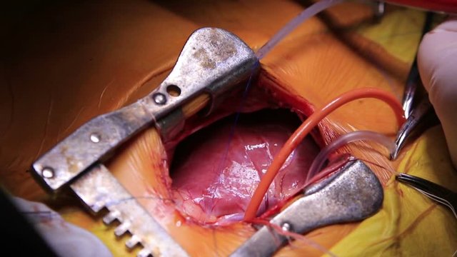 Human heart pulsating connected with tubes of a heart-assist device during the surgery (1080p, 25fps)