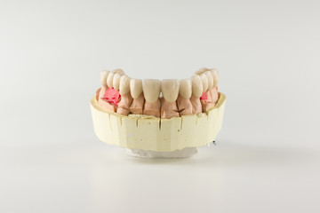 the denture made of ceramics located on plaster model
