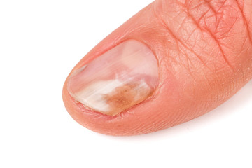 one finger of the hand with a fungus on the nails isolated white background