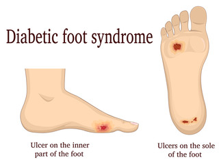 Illustration of diabetic foot syndrome. Shown ulcers on the inside and plantar of the foot.