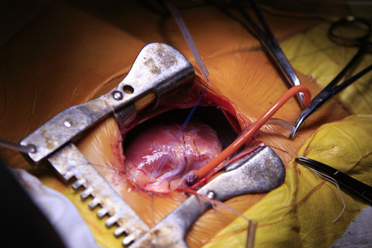 Open heart surgery with different surgical tools and tubes connected to a heart closeup