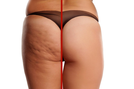 comparing female ass with and without cellulite