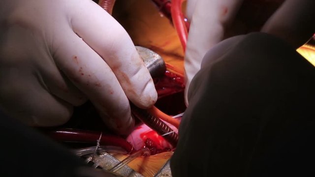 Surgeon ties the tubes for blood circulation of a cardiopulmonary bypass connected to a baby's heart closeup (1080p, 25fps)
