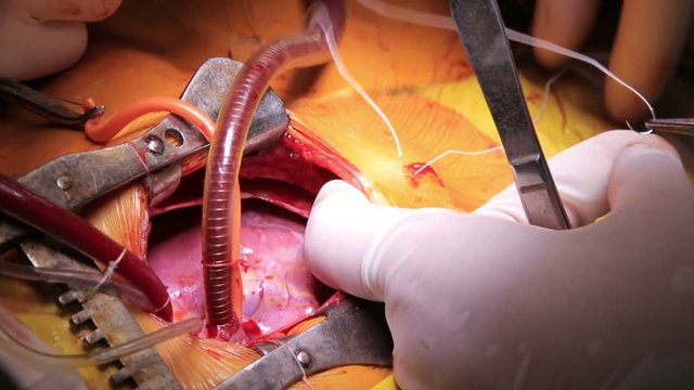 Open heart surgery closeup with surgeon sews the membrane to a skin (1080p, 25fps)
