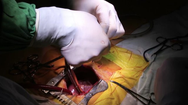 Open heart surgery with two surgeons work with different surgical tools (1080p, 25fps)