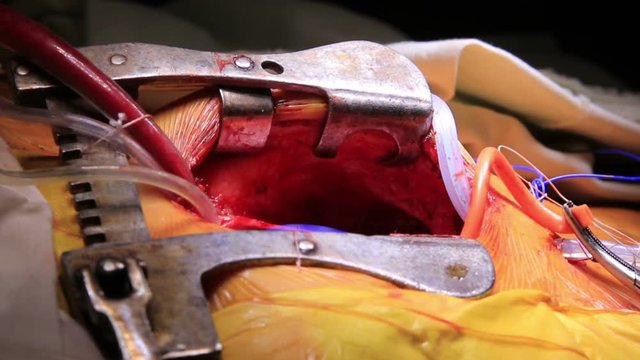 Opened thorax and beating heart inside with tubes and wires connected to (1080p, 25fps)