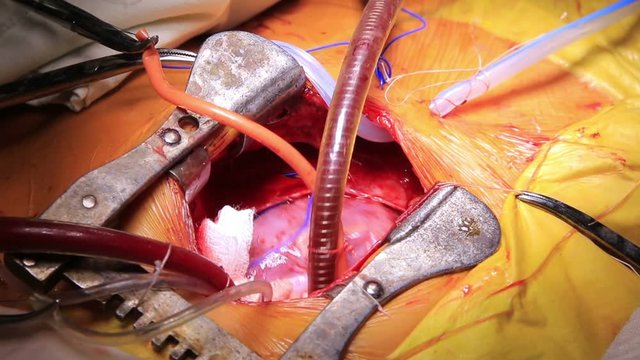 Human heart beats connected to a сardiopulmonary bypass during the open heart surgery closeup (1080p, 25fps)