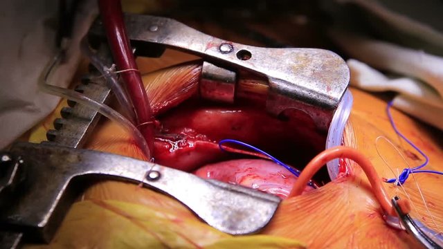 Strong child's heart beats in opened chest connected to cardiopulmonary bypass closeup (1080p, 25fps)