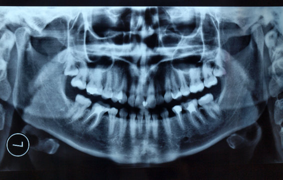 Panoramic X-ray of the jaw and teeth