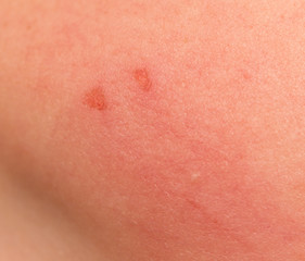 wound on the skin. macro