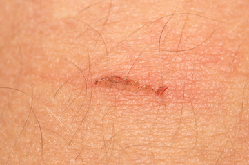 Fototapeta premium wound on the skin. macro
