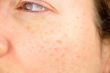 skin of woman with blemish and spots