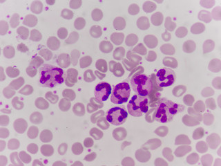 Cancer Cell in human showing abnormal cells.