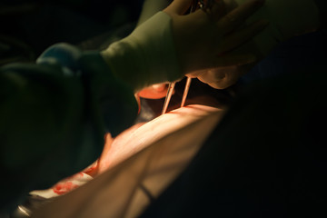 Close up image of a team of doctors delivering a baby via Caesarean section in an operating theatre in a hospital during the act of child birth