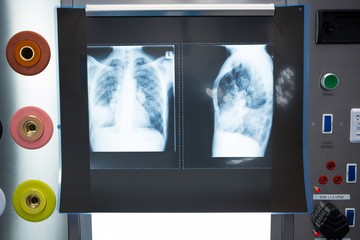Close-up of x-ray on lightbox