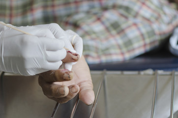 Thumb nail extraction wound.