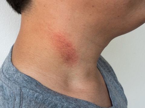 Ringworm,tinea on neck