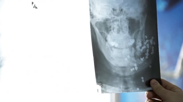 X ray image of a bullet from a gun grapeshot in skull doctor holds in the hand to light