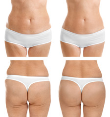 Mature woman body before and after liposuction. Plastic surgery concept.