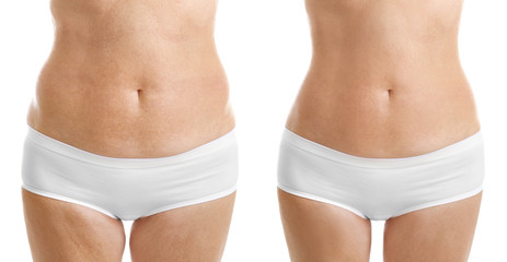 Mature woman body before and after liposuction. Plastic surgery concept.