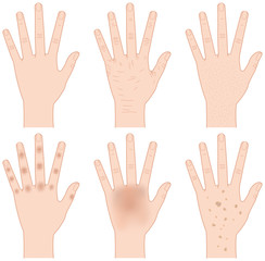 手の悩み　たるみ、しみ、黒ずみ