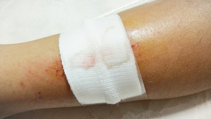 White wound in the leg.