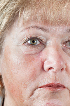 Mature woman with gradually fading scar one month after Mohs surgery for Basal Cell Carcinoma