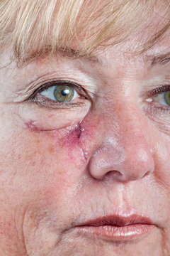 Mature woman with scar and spitting suture one week after Mohs surgery for Basal Cell Carcinoma