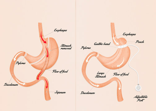 gastric bypass and gastric band