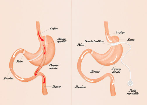 gastric bypass and gastric band