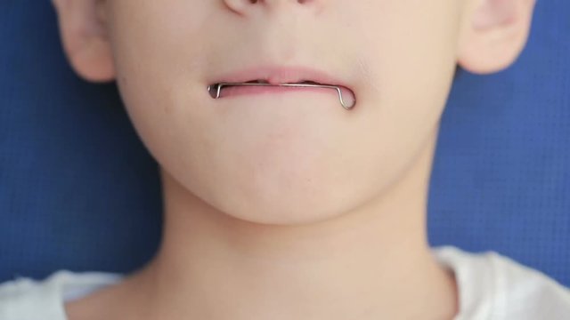 smiling child with braces on teeth
