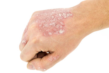 psoriasis on the hand isolated on white