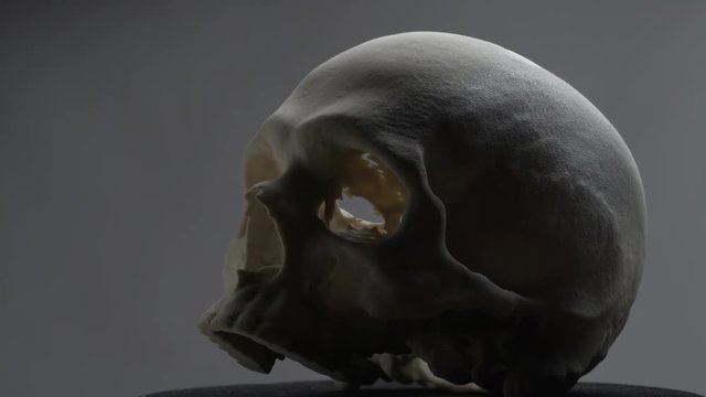 cranioplasty human skull model