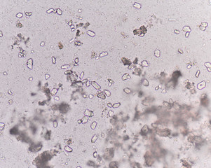 Moderate triple phosphate with bacteria in urine analysis medica