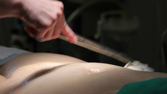 Bare female belly sterilization with wet gauze holden in the clamp close-up before the surgery (1080p, 25fps)
