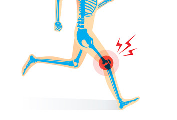 Injury of knee bone and leg while human running. Illustration about medical and sport.