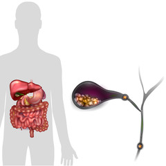 Gallstones in the Gallbladder, anatomy bright detailed illustration.