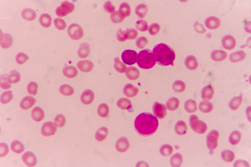 Blast cells in Leukemia