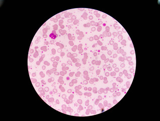 Slide blood smear show giant platelet and neutrophil under micro