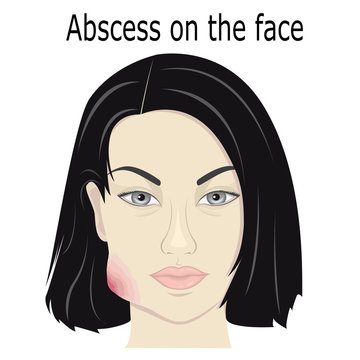 Illustration abscess on the face of a young girl