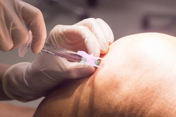 Anaesthetic injection in surgery