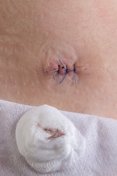 Naht von Leberfleckentfernung