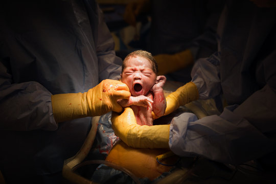 C-section birth of a baby. First breath.