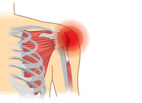 Human shoulder muscles and joints have a red signal. Illustration about chronic pain.