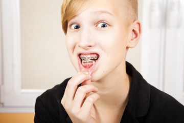 Teen with braces on his teeth. Orthodontics and bite correction.